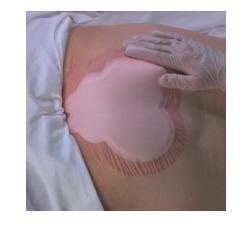 MEDICAZIONE IDROCELLULARE ADESIVA STERILE CONFORMATA PER LA REGIONE SACRALE ASSORBENTE IN SCHIUMA DI POLIURETANO ALLEVYN SACRUM 22,5X22,1CM 10PZ - Angeli Pharm